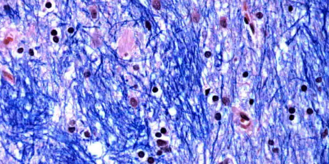 Huntington’s Disease Linked to Expanding DNA Mutation - McLean Hospitals Harvard Brain Tissue Resources Center/NIH NeuroBioBank via AP