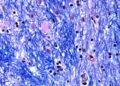 Huntington’s Disease Linked to Expanding DNA Mutation - McLean Hospitals Harvard Brain Tissue Resources Center/NIH NeuroBioBank via AP