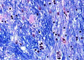 Huntington’s Disease Linked to Expanding DNA Mutation - McLean Hospitals Harvard Brain Tissue Resources Center/NIH NeuroBioBank via AP