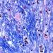 Huntington’s Disease Linked to Expanding DNA Mutation - McLean Hospitals Harvard Brain Tissue Resources Center/NIH NeuroBioBank via AP