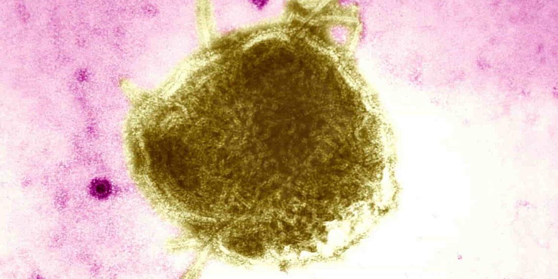 Texas Counties See Growing Measles Outbreak Amid Low Vaccination Rates - BSIP/UIG Via Getty Images