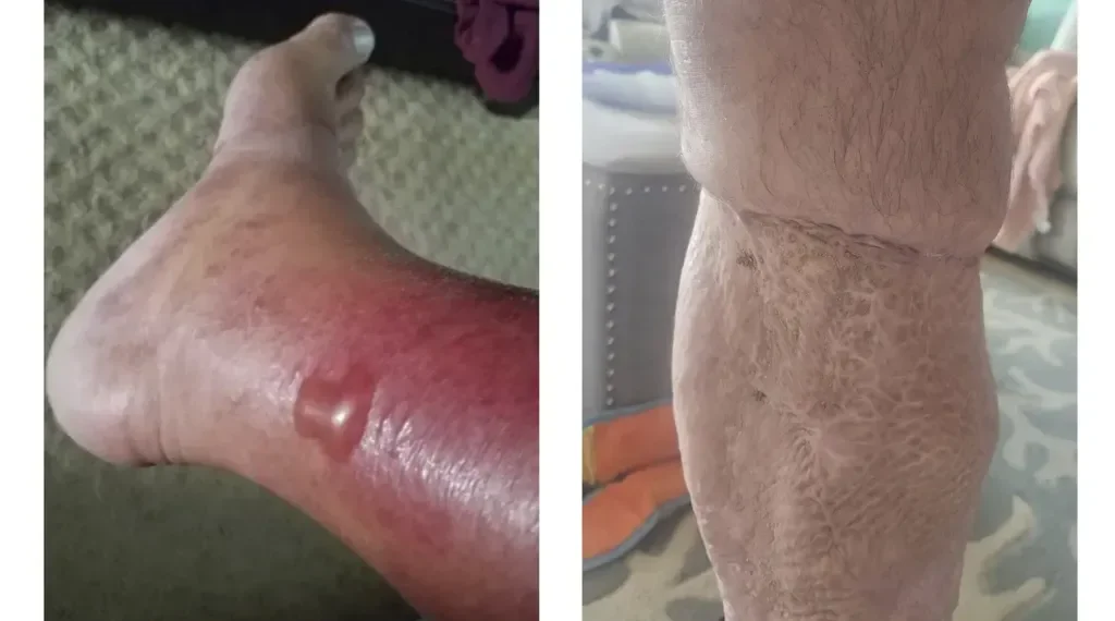 Vibrio Vulnificus: How to Stay Safe From Deadly Coastal Water Bacteria Linked to Raw Oysters, Open Wounds, and Rising Summer Cases - Karrianne Stewart via AP