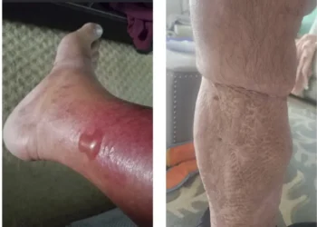 Vibrio Vulnificus: How to Stay Safe From Deadly Coastal Water Bacteria Linked to Raw Oysters, Open Wounds, and Rising Summer Cases - Karrianne Stewart via AP