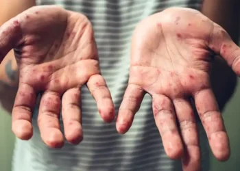 189 HFMD Cases Confirmed in U.S. Virgin Islands Amid Growing National Outbreaks - iStock