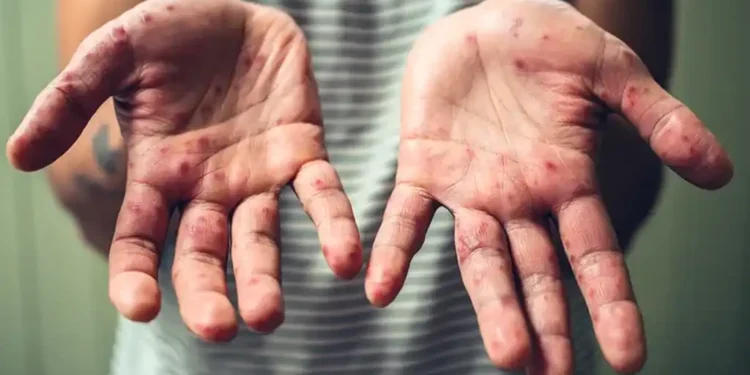 189 HFMD Cases Confirmed in U.S. Virgin Islands Amid Growing National Outbreaks - iStock